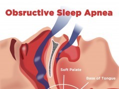 obstructive sleep apnea didgeridoo natural sleep apnea therapy
